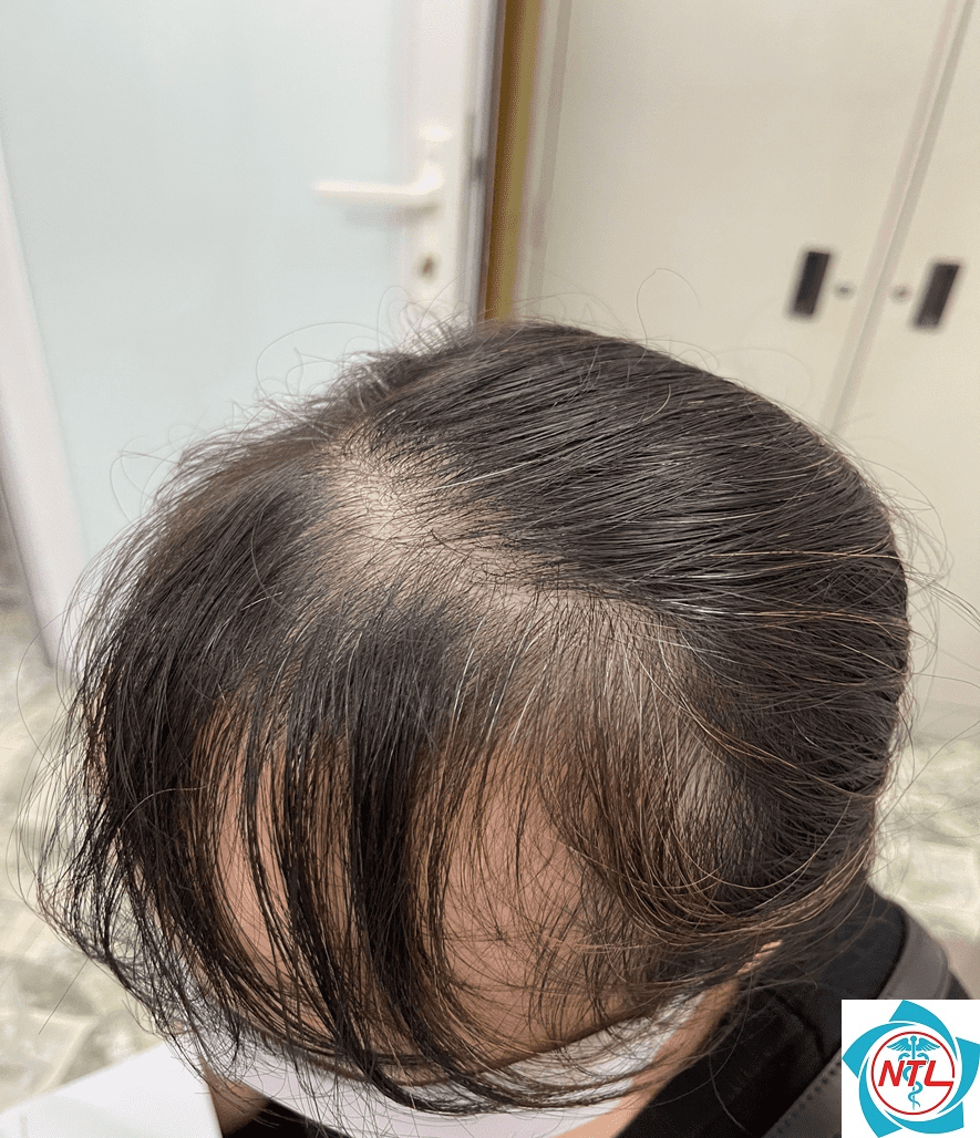 rụng tóc sau sốt - Image 1