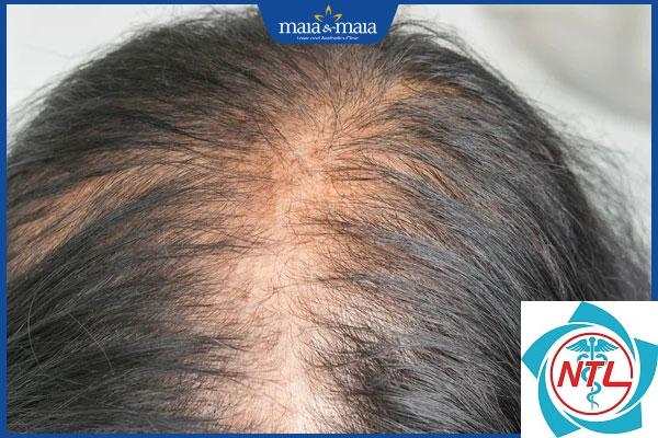 rụng tóc thời kỳ mãn kinh - Image 2