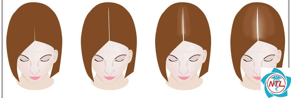 rụng tóc thời kỳ mãn kinh - Image 3