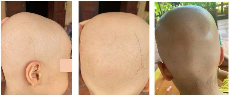 rụng tóc toàn thân