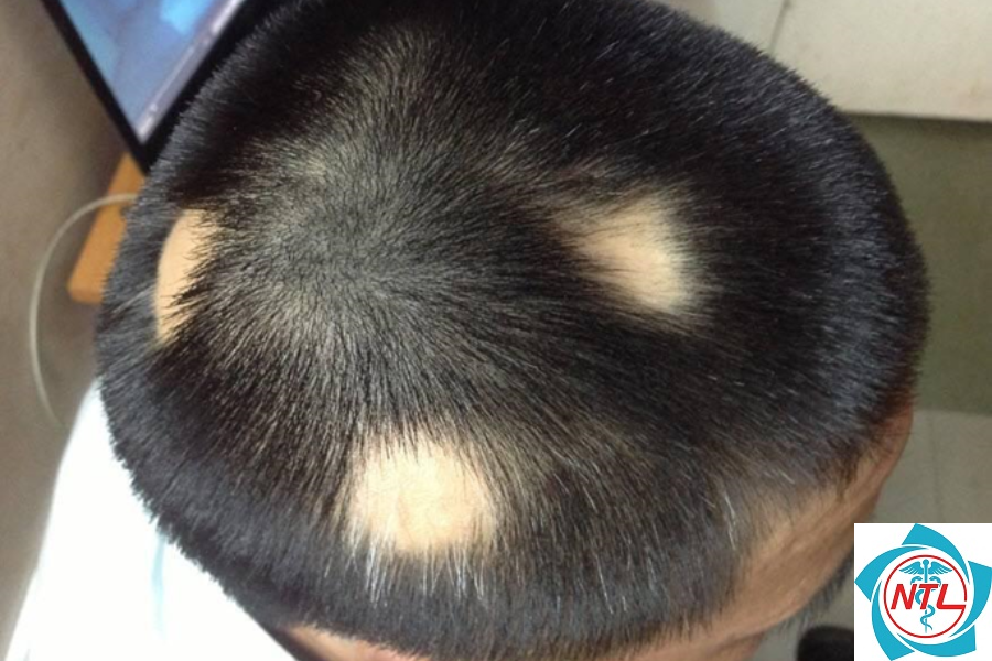 rụng tóc từng mảng da đầu - Image 2