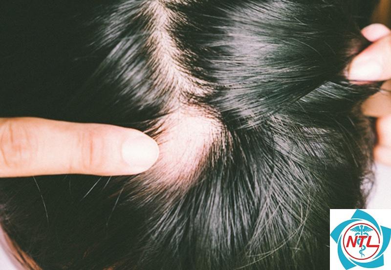 rụng tóc từng mảng da đầu - Image 3