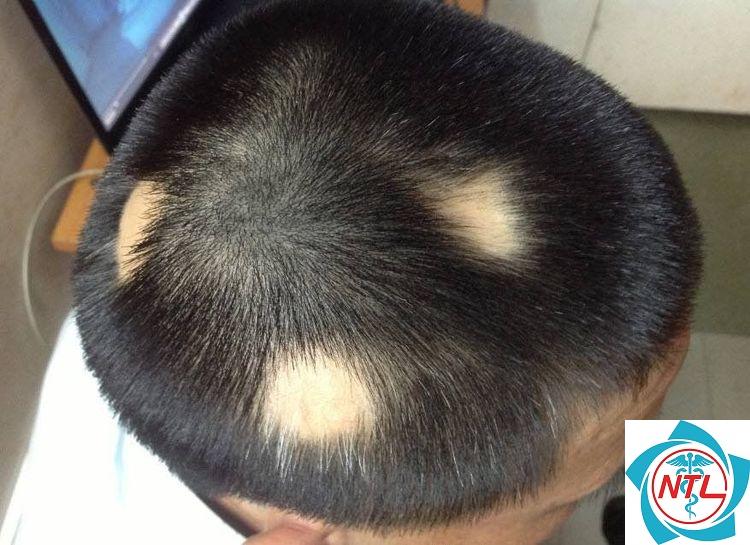 rụng tóc từng mảng ở trẻ em - Image 2