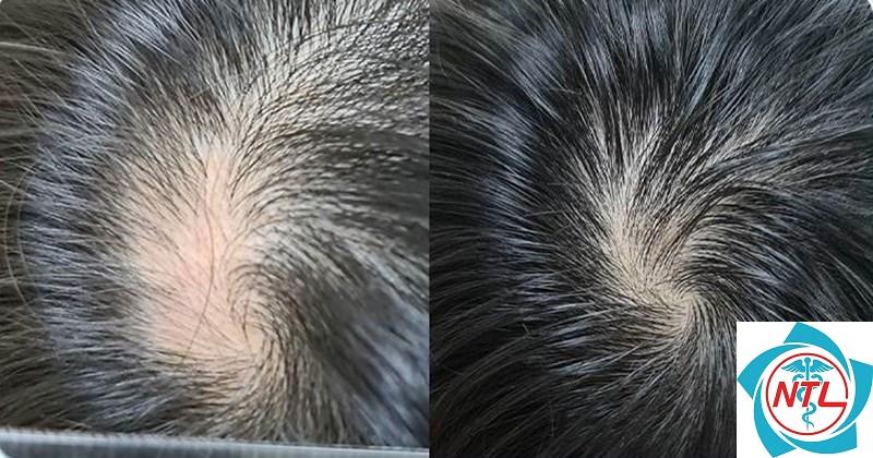 rụng tóc từng mảng ở trẻ em