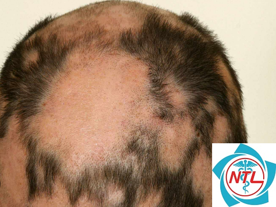 rụng tóc từng mảng toàn thân - Image 3