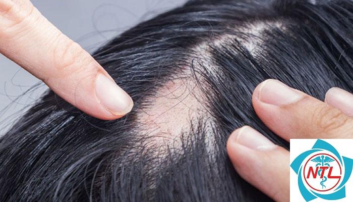 rụng tóc từng mảng toàn thân - Image 4