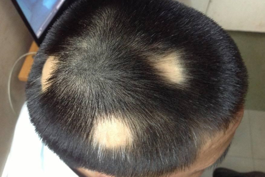 rụng tóc từng vùng - Image 2