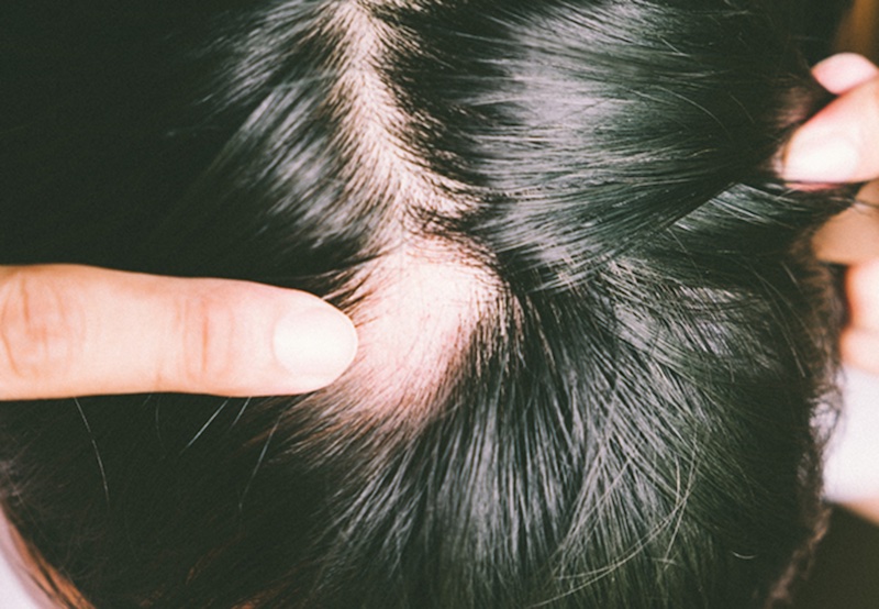 rụng tóc từng vùng - Image 3