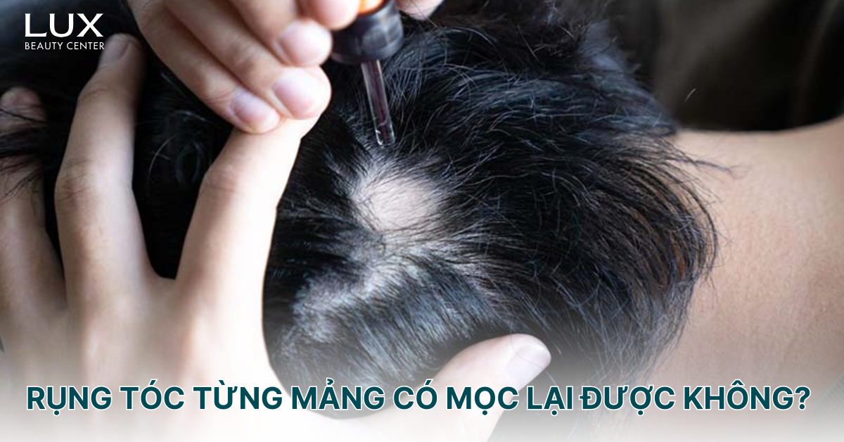 rụng tóc từng vùng - Image 4