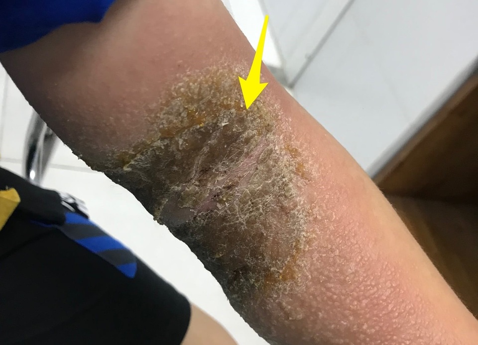sau khi bó bột tay bị sưng - Image 2