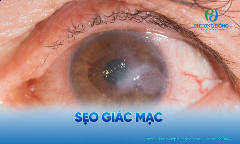 sẹo giác mạc - Image 2