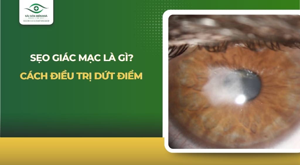 sẹo giác mạc - Image 4