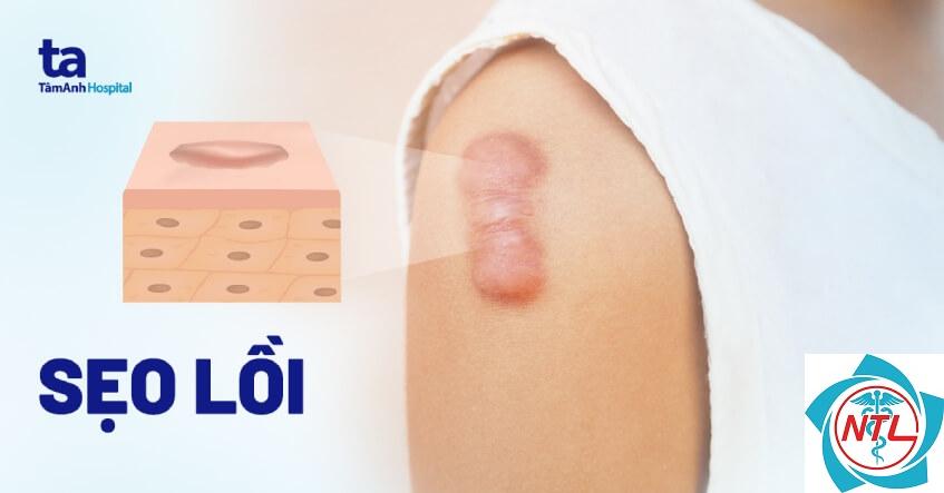 sẹo lồi - Image 4