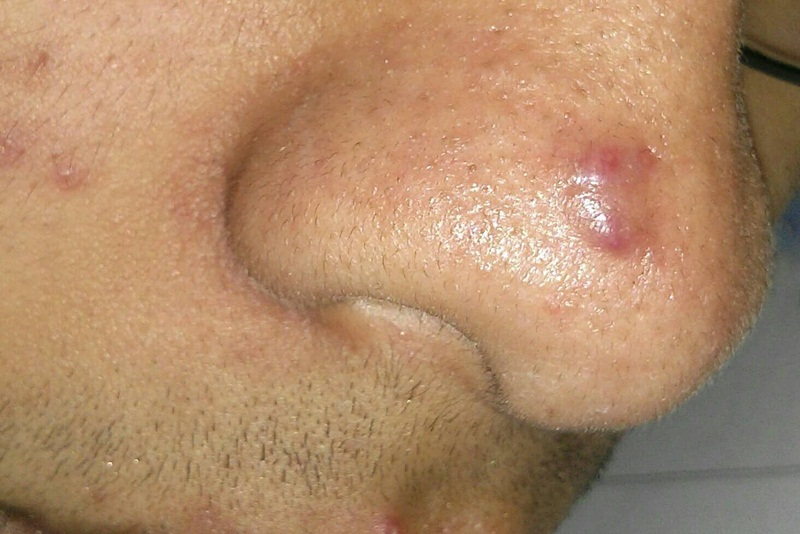 sẹo lồi do mụn - Image 2