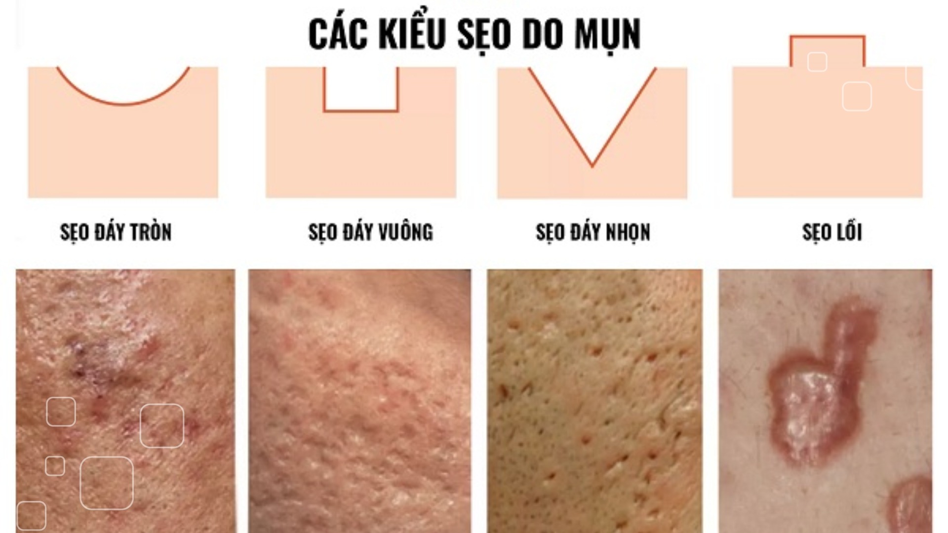 sẹo lồi do mụn - Image 3