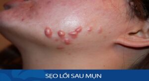 sẹo lồi do mụn