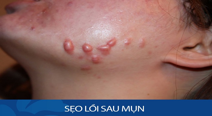sẹo lồi do mụn