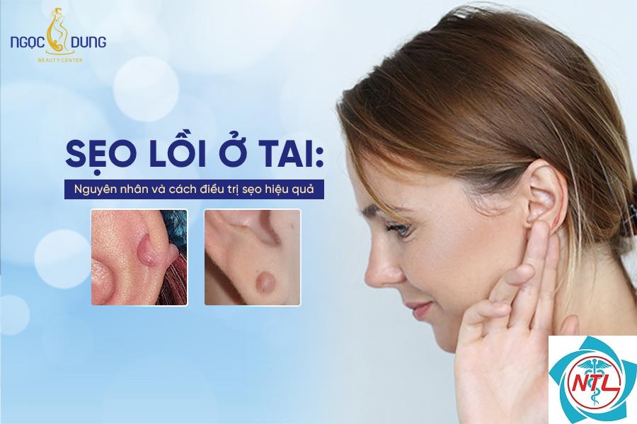sẹo lồi ở tai - Image 5