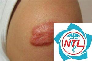 sẹo lồi sau chấn thương