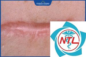 sẹo lồi sau phẫu thuật