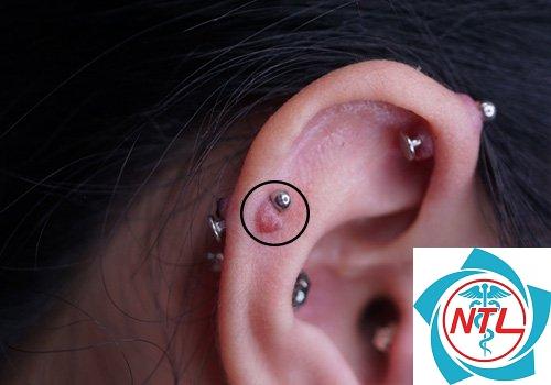 sẹo lồi sau xỏ khuyên - Image 2