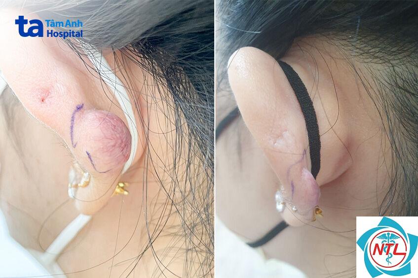 sẹo lồi sau xỏ khuyên - Image 3