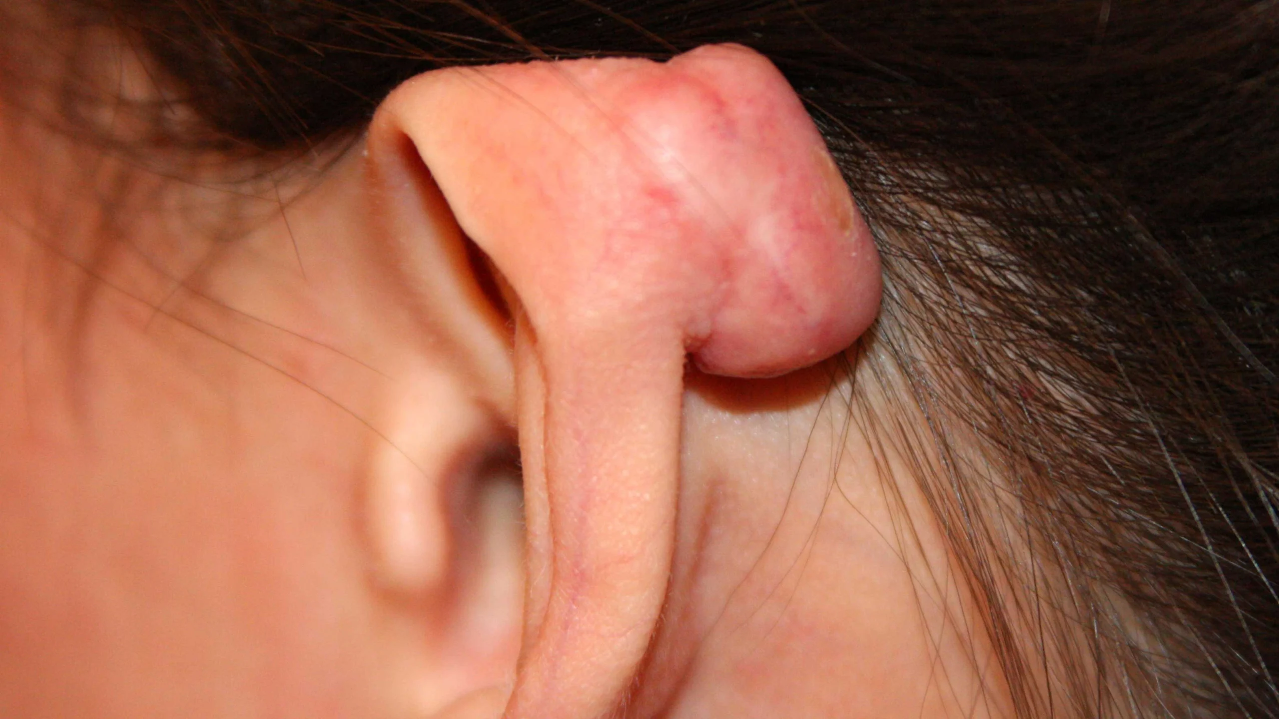 sẹo lồi sau xỏ khuyên - Image 1