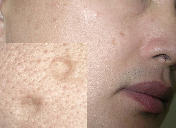 sẹo lõm do mụn - Image 2