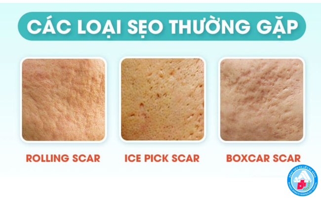 sẹo lõm do mụn - Image 3