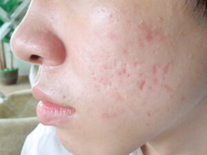 sẹo lõm do mụn