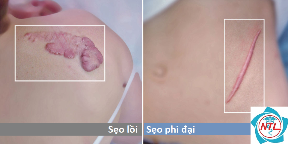 sẹo phì đại - Image 2