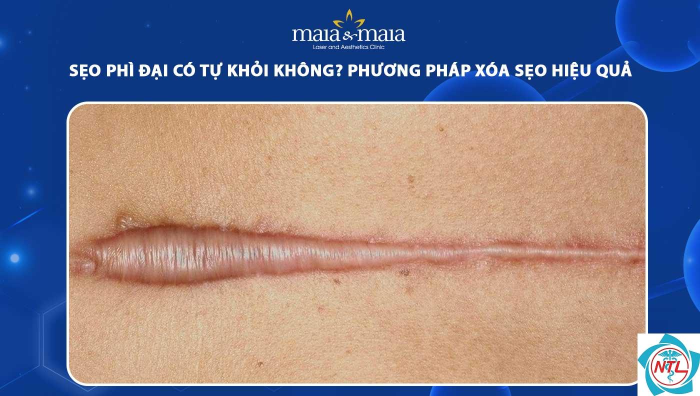 sẹo phì đại - Image 3