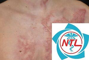 sẹo phì đại sau bỏng