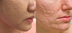 sẹo rỗ do mụn