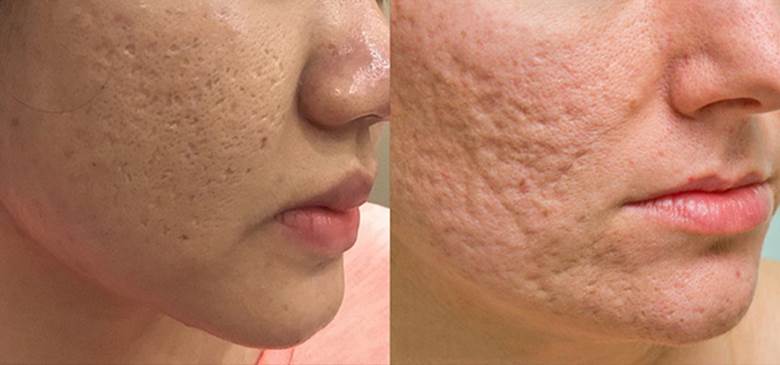sẹo rỗ do mụn