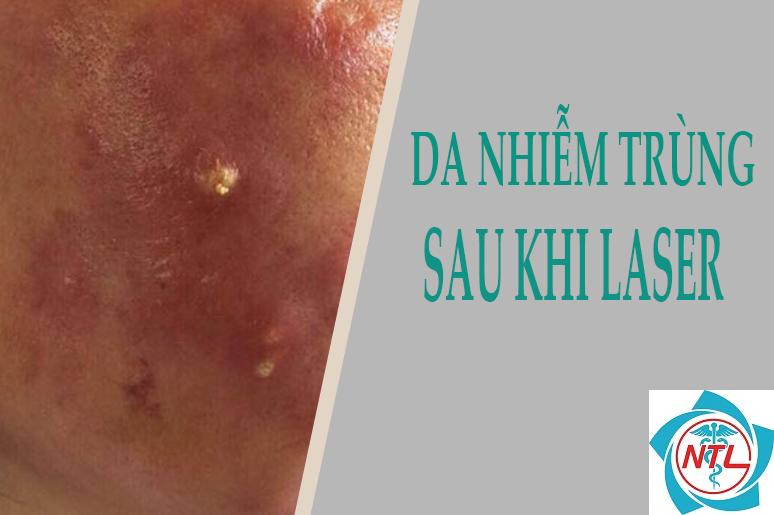 sẹo sau nhiễm trùng da - Image 2