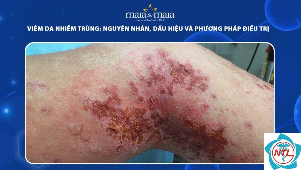 sẹo sau nhiễm trùng da - Image 3