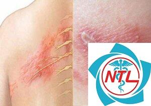 sẹo sau nhiễm trùng da