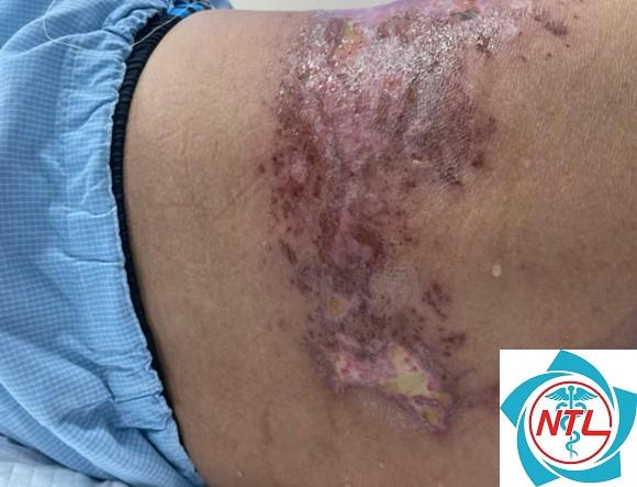 sẹo sau nhiễm trùng da - Image 4