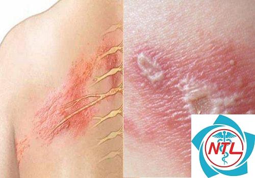 sẹo sau nhiễm trùng da