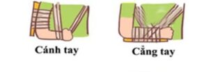 sơ cứu gãy xương cẳng tay