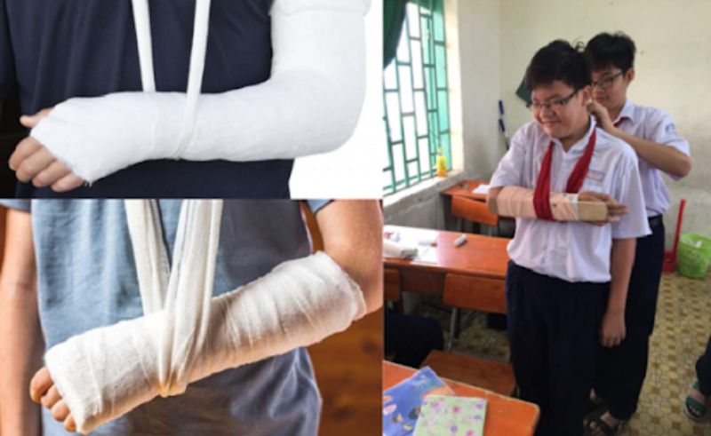 sơ cứu gãy xương cẳng tay - Image 2