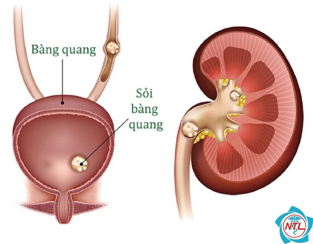 sỏi bàng quang