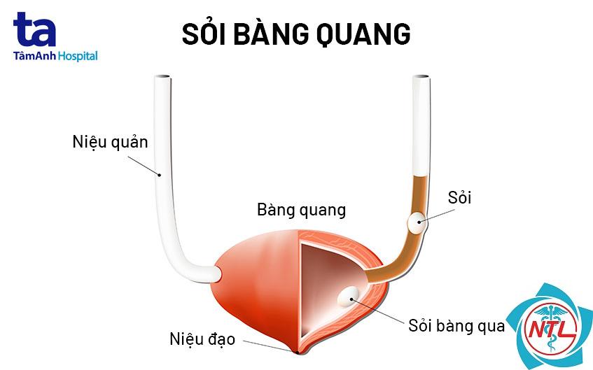 sỏi bàng quang - Image 2