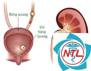 sỏi bàng quang