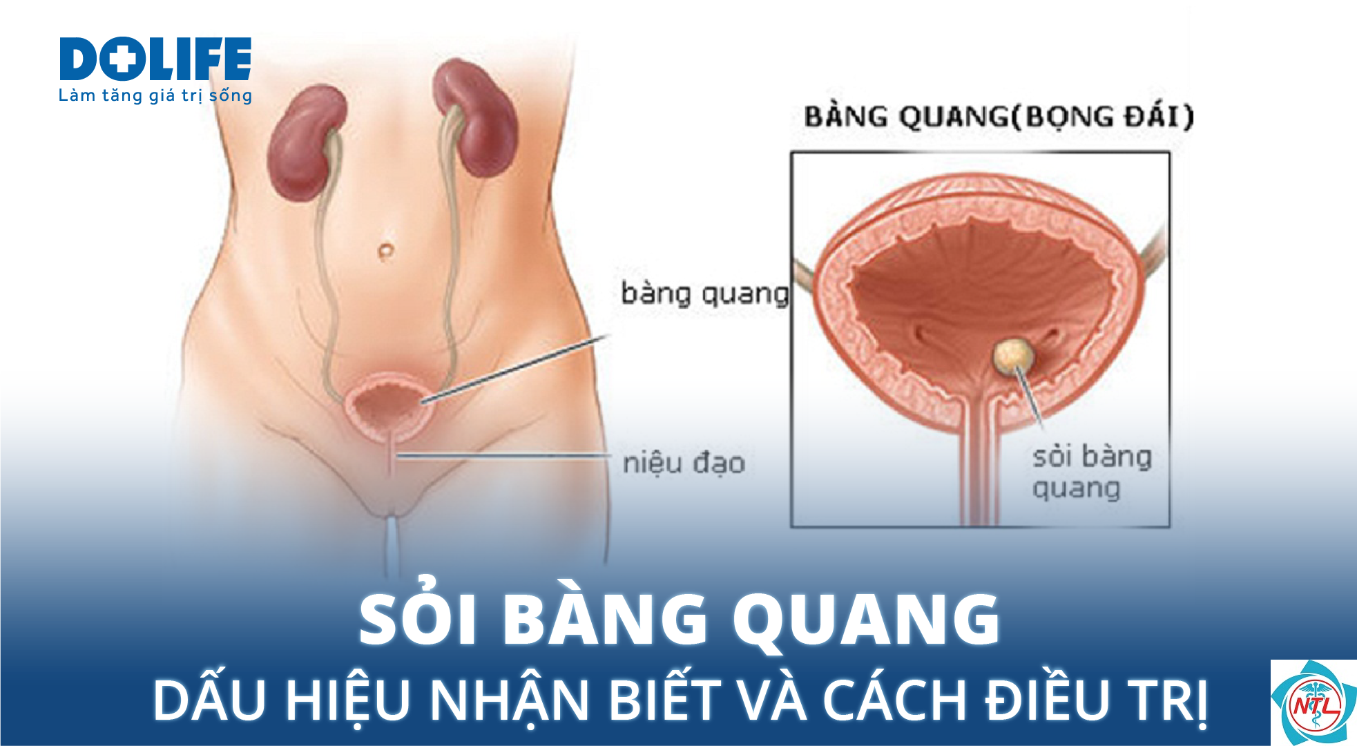 sỏi bàng quang - Image 5