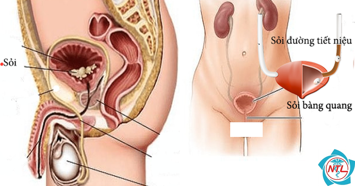 sỏi bàng quang ở người cao tuổi - Image 3