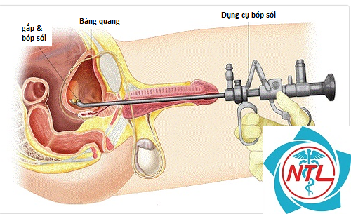 sỏi bàng quang tái phát - Image 3