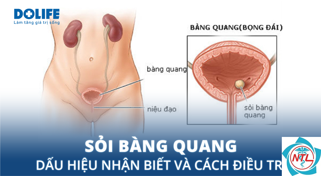 sỏi bàng quang tái phát - Image 5