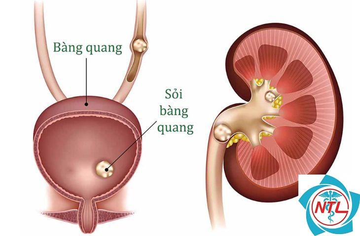sỏi bàng quang tái phát
